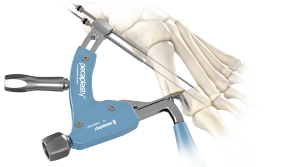 Pecaplasty targeting guide 2.0